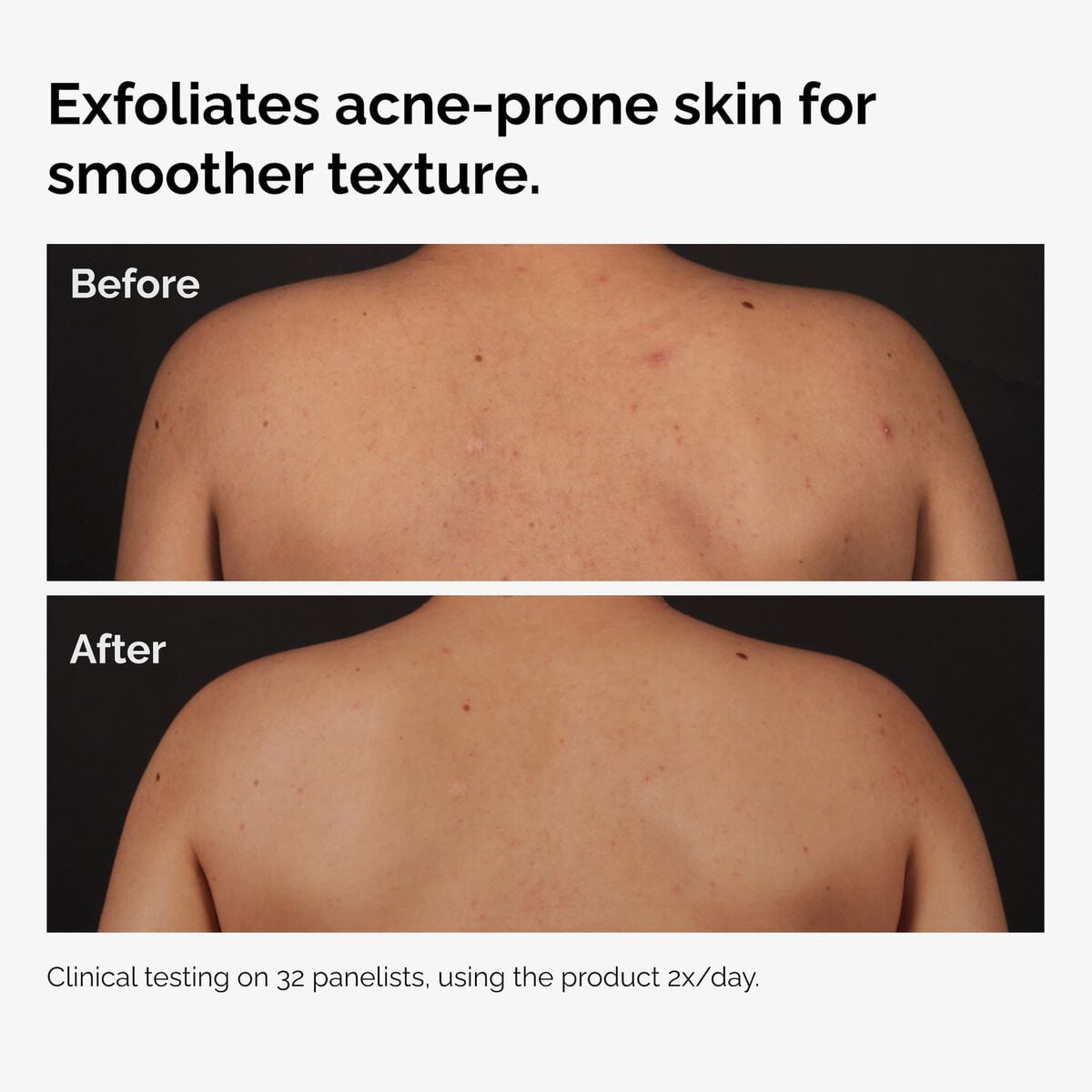 Salicylic Acid Body Serum Targeted Serum Care P1
